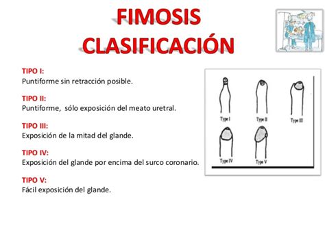 foto fimosis|La fimosis: Qué es, Tipos, Grados y Solución